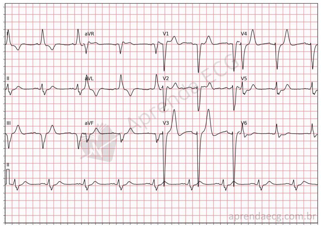 Electrocardiogram showing peripheral intraventricular block