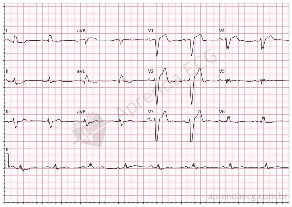 Electrocardiogram showing left bundle branch block with QRS fragmentation