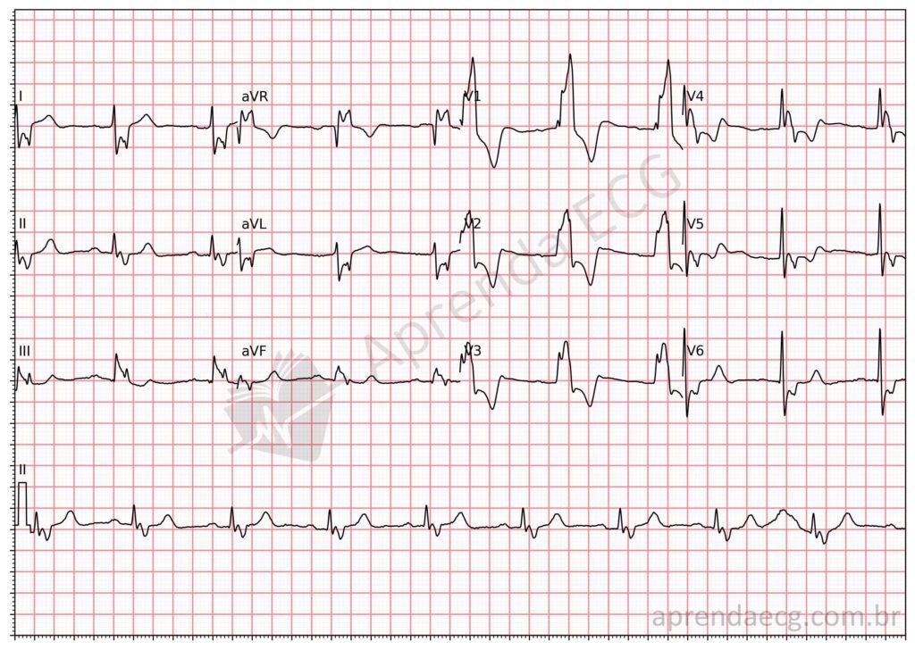 Electrocardiogram showing right bundle branch block with QRS fragmentation