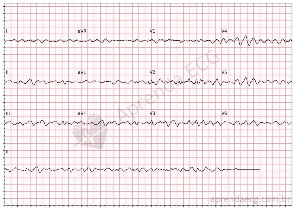 Electrocardiogram showing ventricular fibrillation