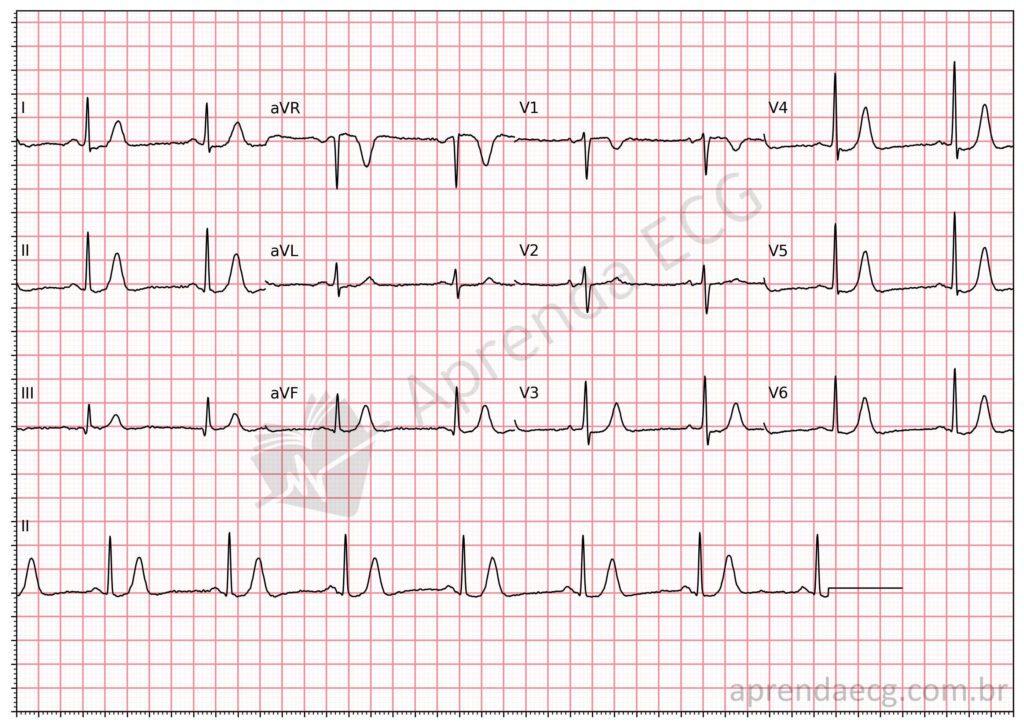 Electrocardiogram showing hyperkalemia