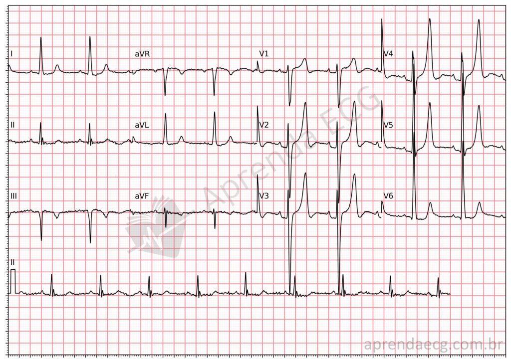 Electrocardiogram showing hyperkalemia