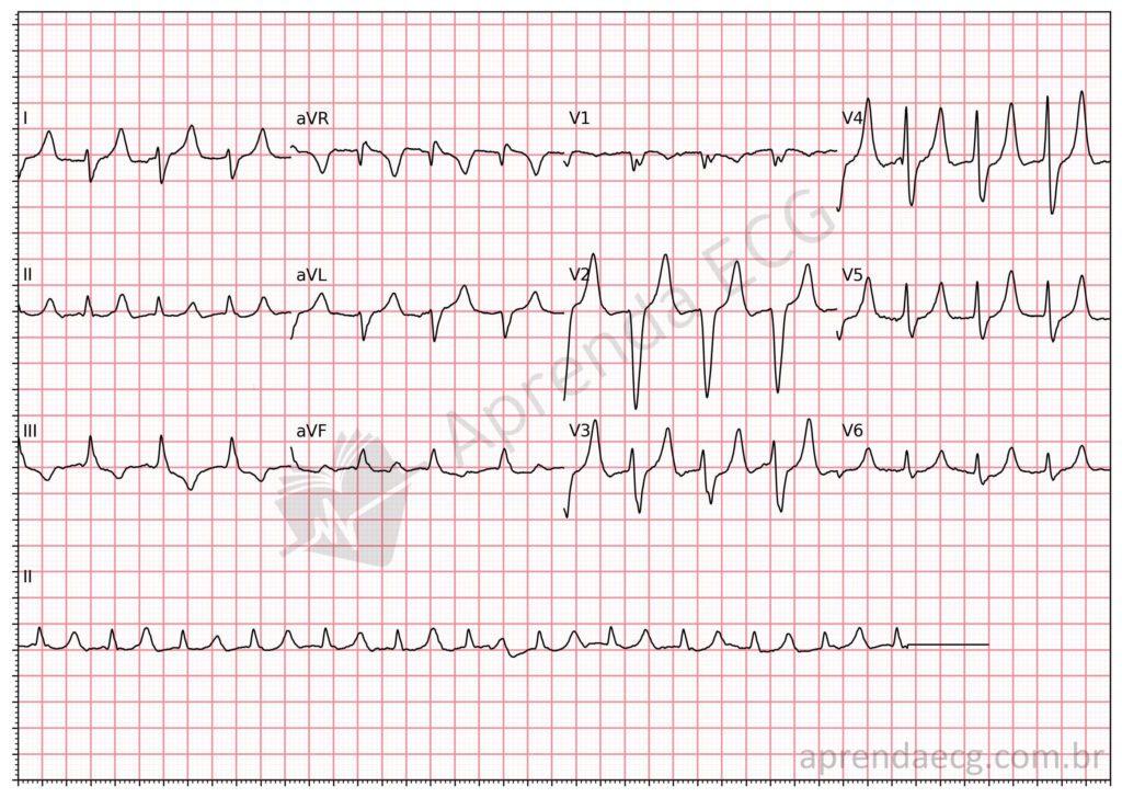 Electrocardiogram showing hyperkalemia