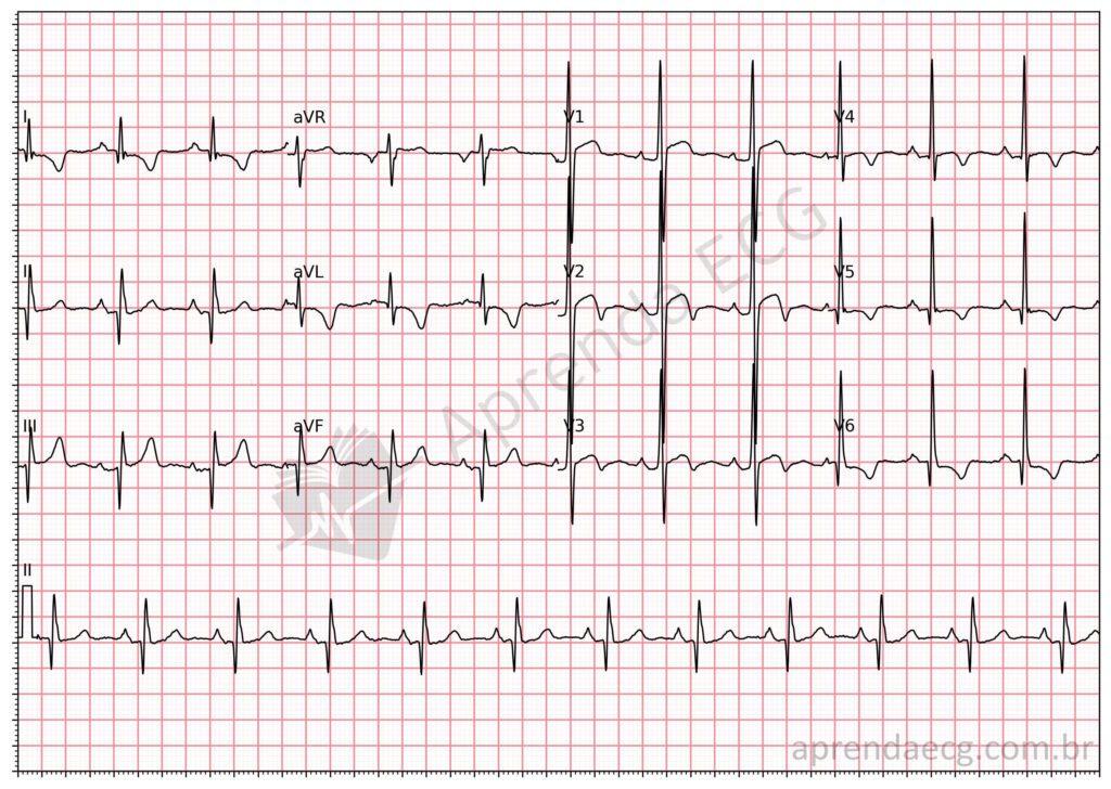 Electrocardiogram showing hypertrophic cardiomyopathy