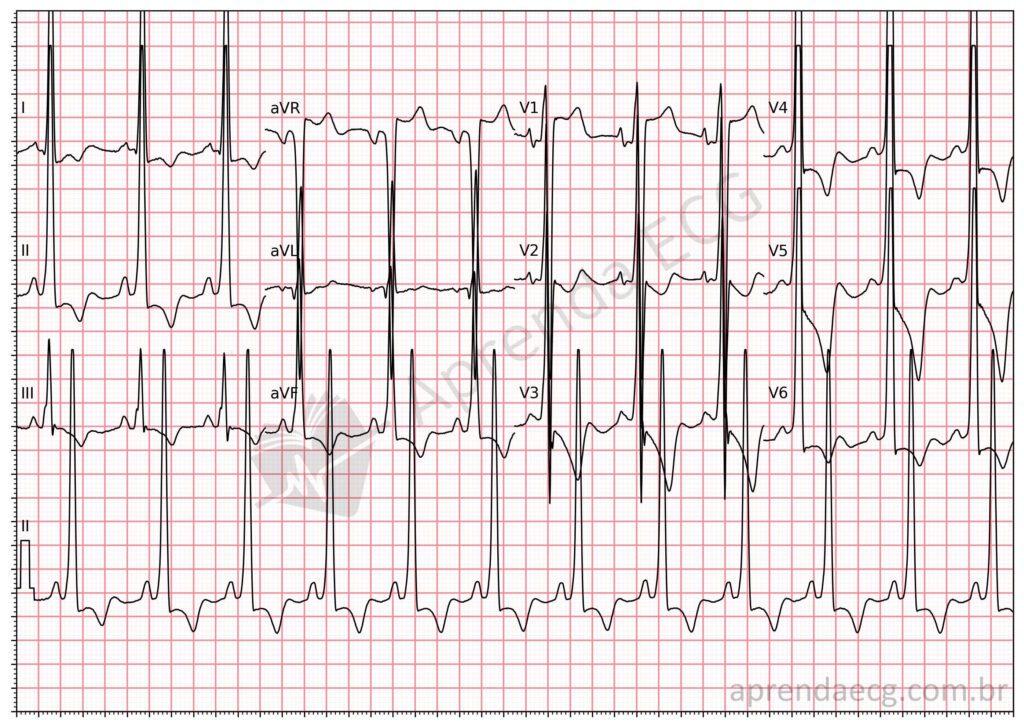 Electrocardiogram showing hypertrophic cardiomyopathy