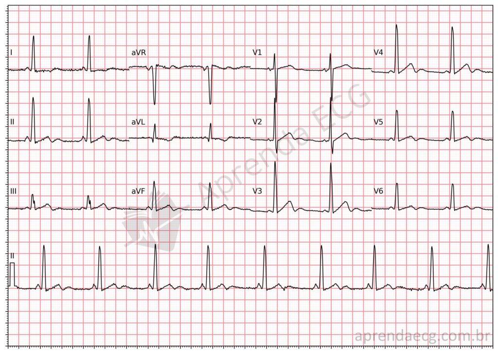 Electrocardiogram showing hypokalemia with U waves