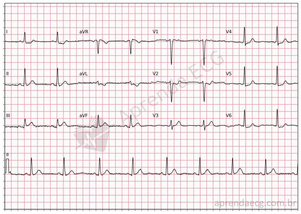 Electrocardiogram with ST depression in aVL
