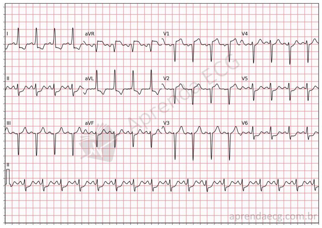 Eletrocardiograma com isquemia circunferencial