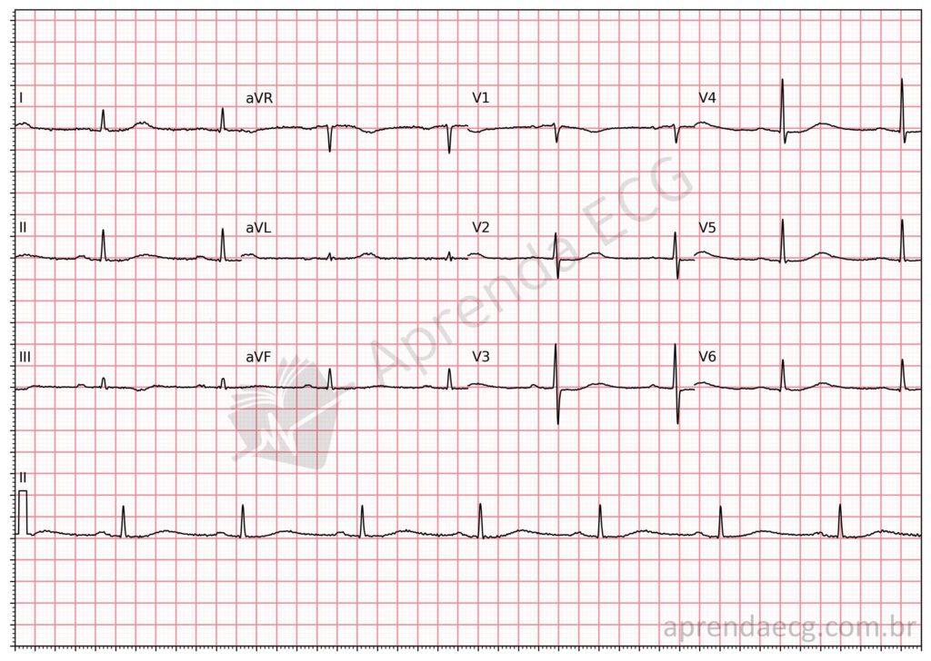 Electrocardiogram with long QT