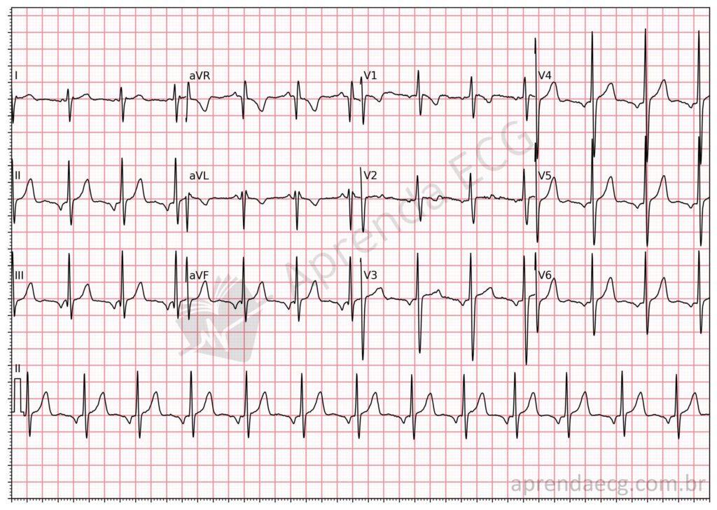 Electrocardiogram showing ectopic atrial rhythm