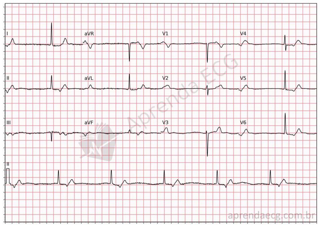 Electrocardiogram showing a junctional escape rhythm