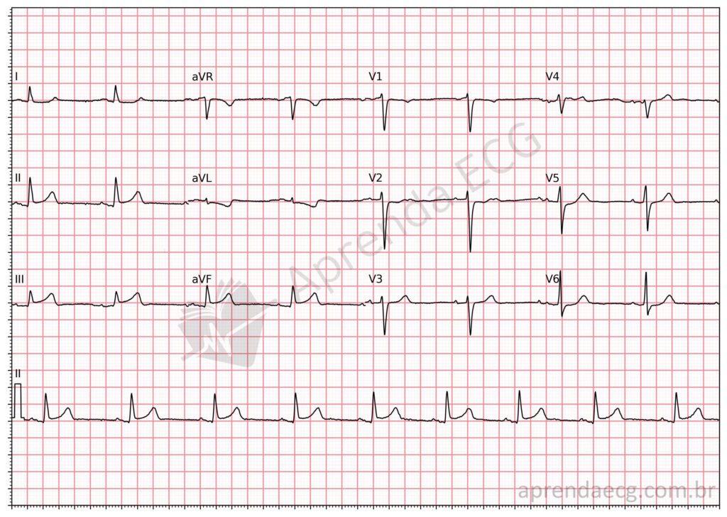 Electrocardiogram with subtle ST-segment elevation