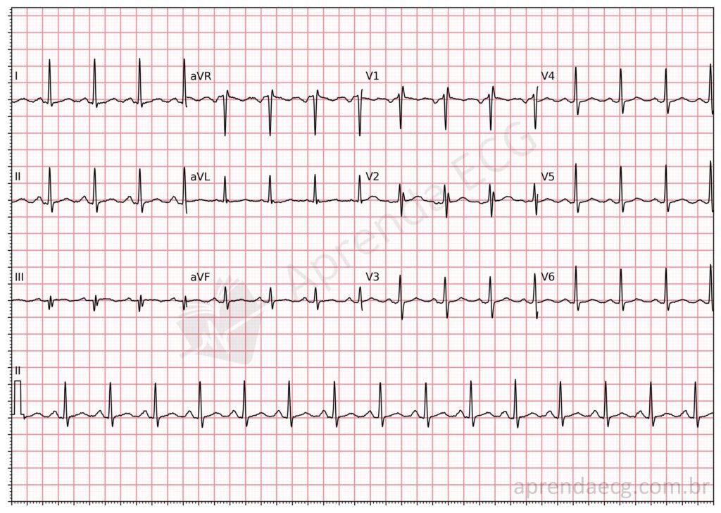 Electrocardiogram showing sinus tachycardia
