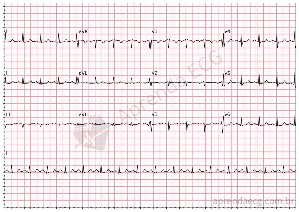 Electrocardiogram after conversion of AV nodal reentrant tachycardia with adenosine