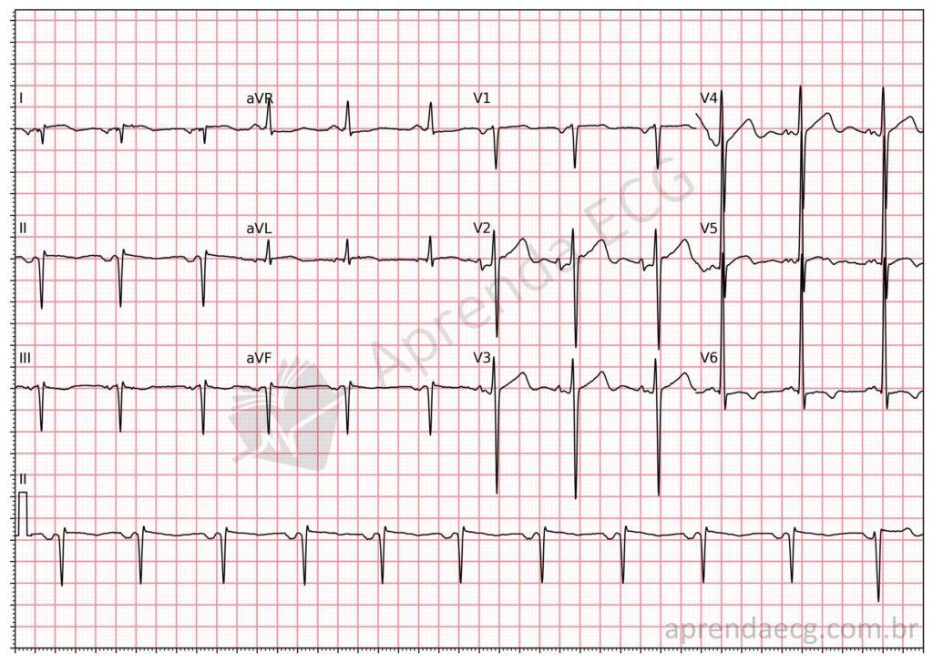 Electrocardiograma con intercambio de electrodos