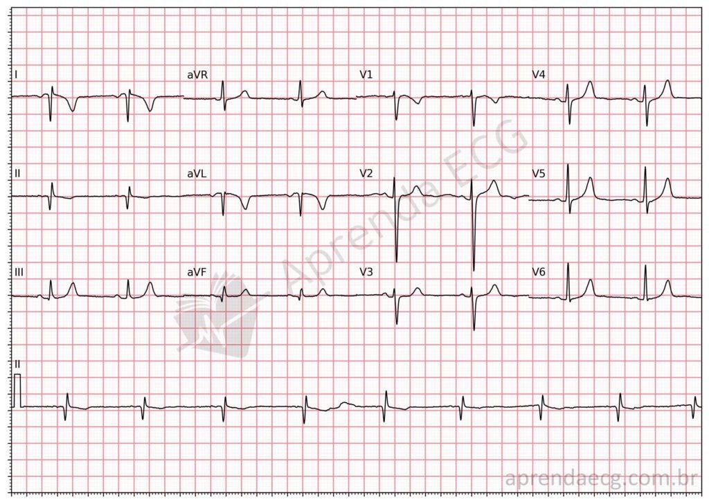 Electrocardiograma con intercambio de electrodos