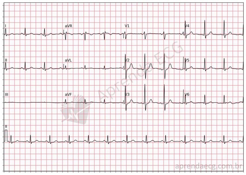 Electrocardiograma con intercambio de electrodos