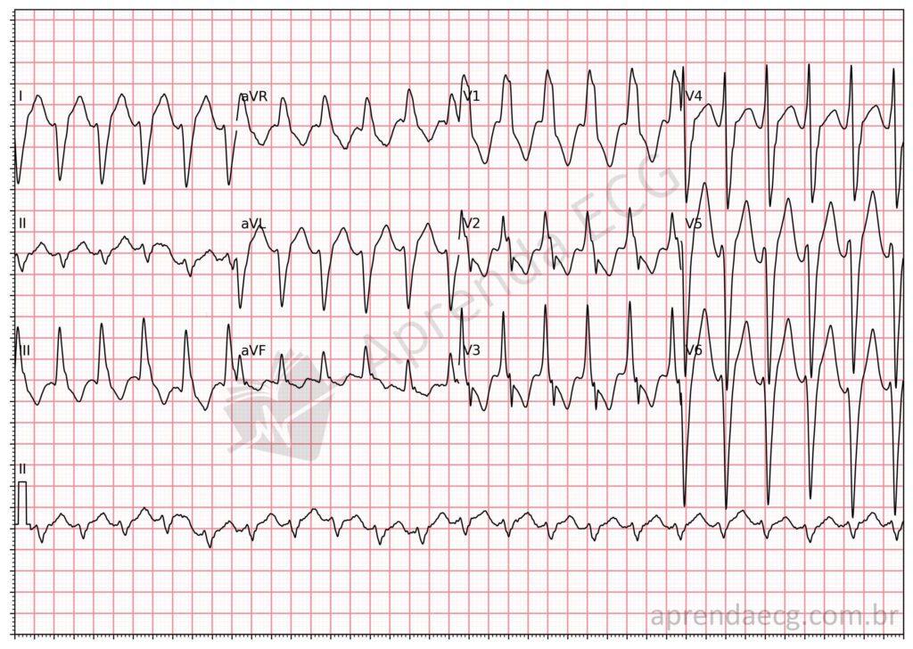 Electrocardiogram showing ventricular tachycardia