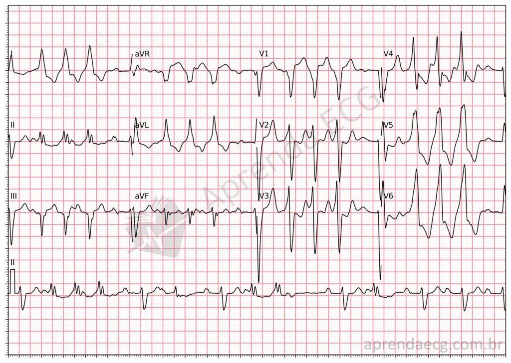 Electrocardiogram showing nonsustained ventricular tachycardia