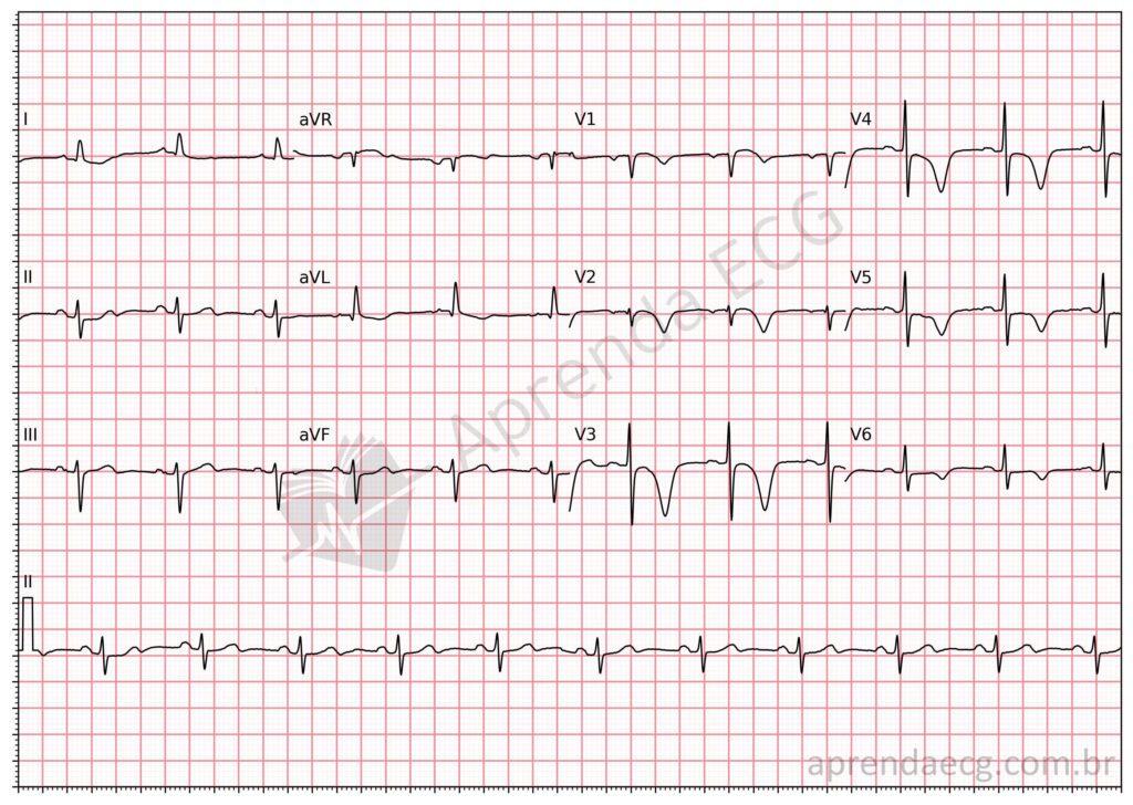 Electrocardiogram with Wellens syndrome and negative T wave