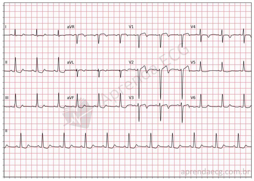 Electrocardiogram with Wellens syndrome and plus-minus T wave