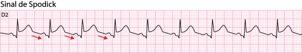Electrocardiographic tracing showing Spodick's sign in acute pericarditis