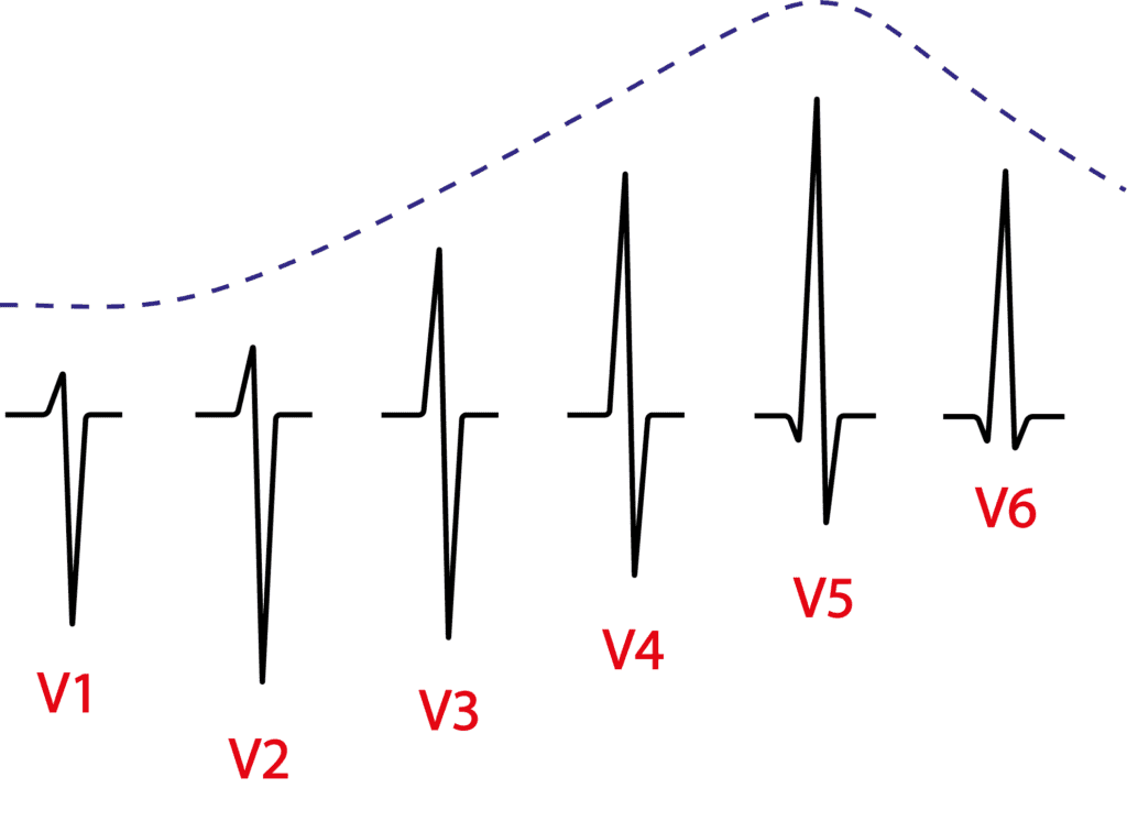 Drawing of normal R-wave progression on the electrocardiogram in leads V1 to V6
