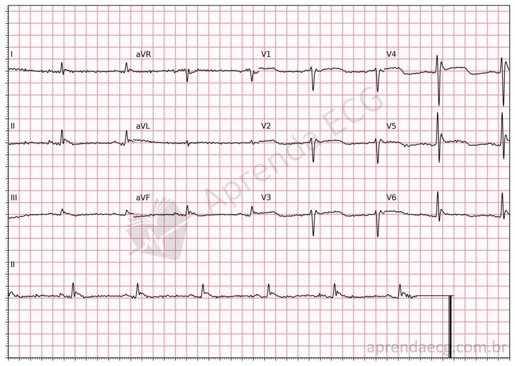 Electrocardiograma en la hipotermia