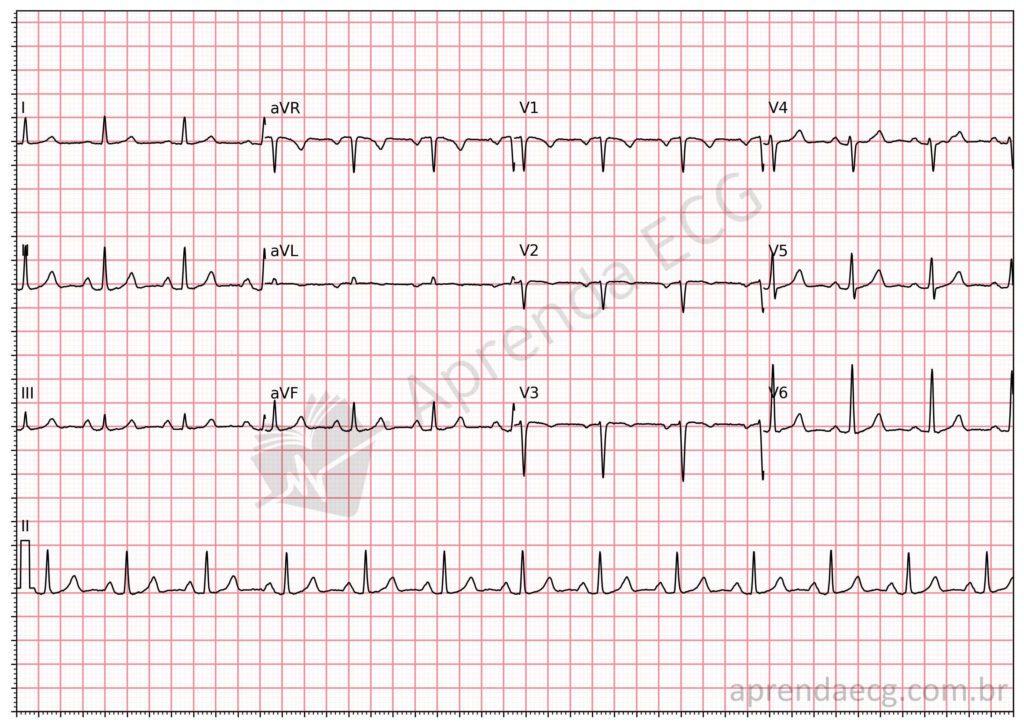 Electrocardiogram showing poor R-wave progression