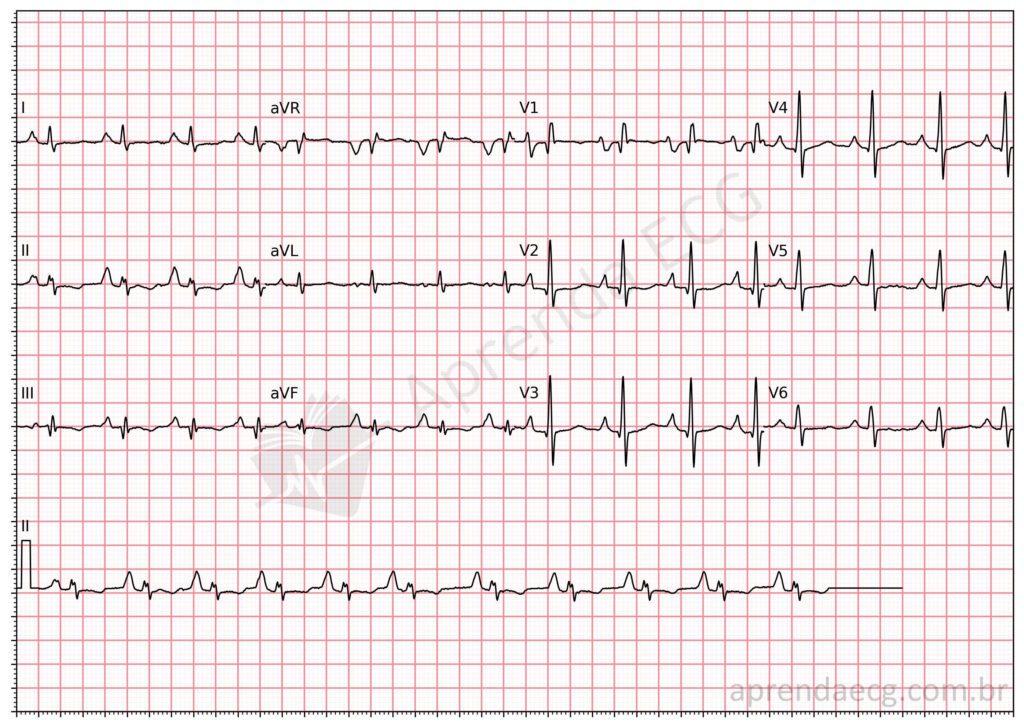 Electrocardiogram showing biatrial enlargement, meeting criteria for both left and right atrial enlargement.