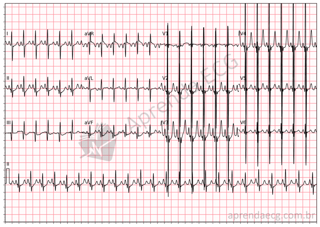 Electrocardiogram showing biventricular hypertrophy and the Katz-Wachtel phenomenon