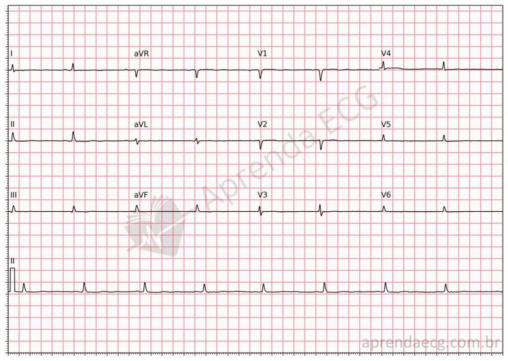 Electrocardiogram showing low QRS voltage