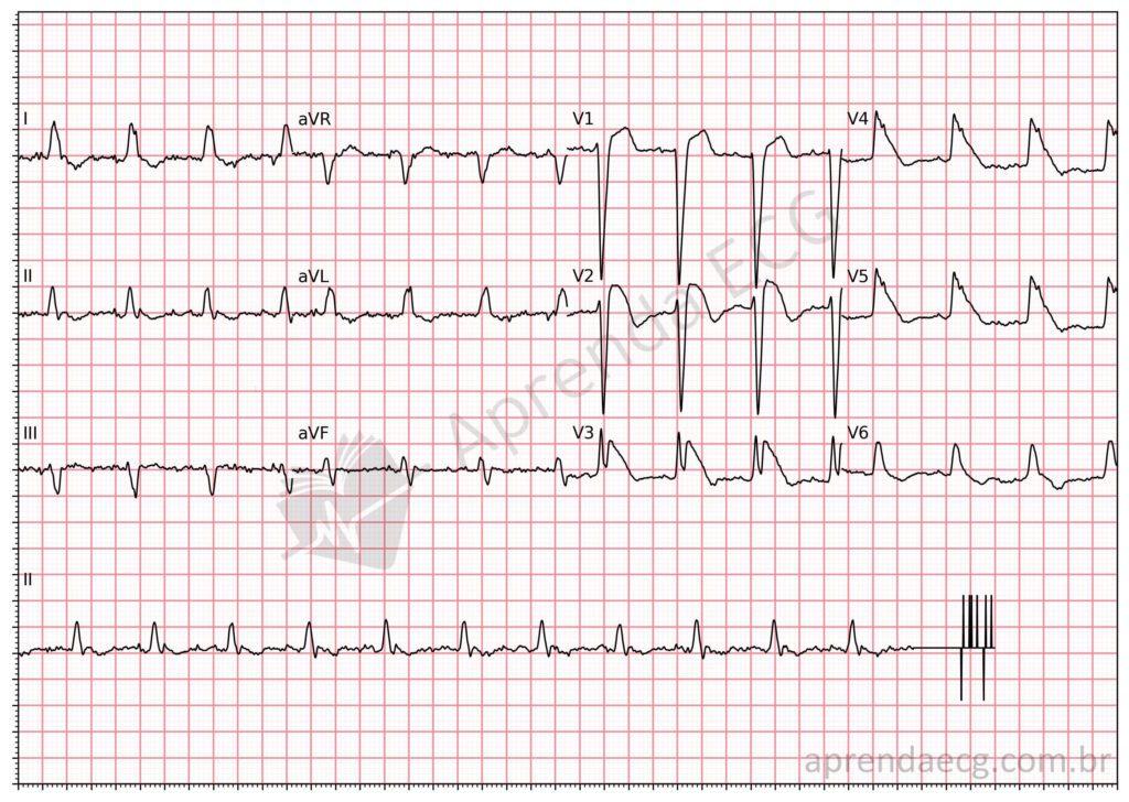 Electrocardiogram with the shark fin sign