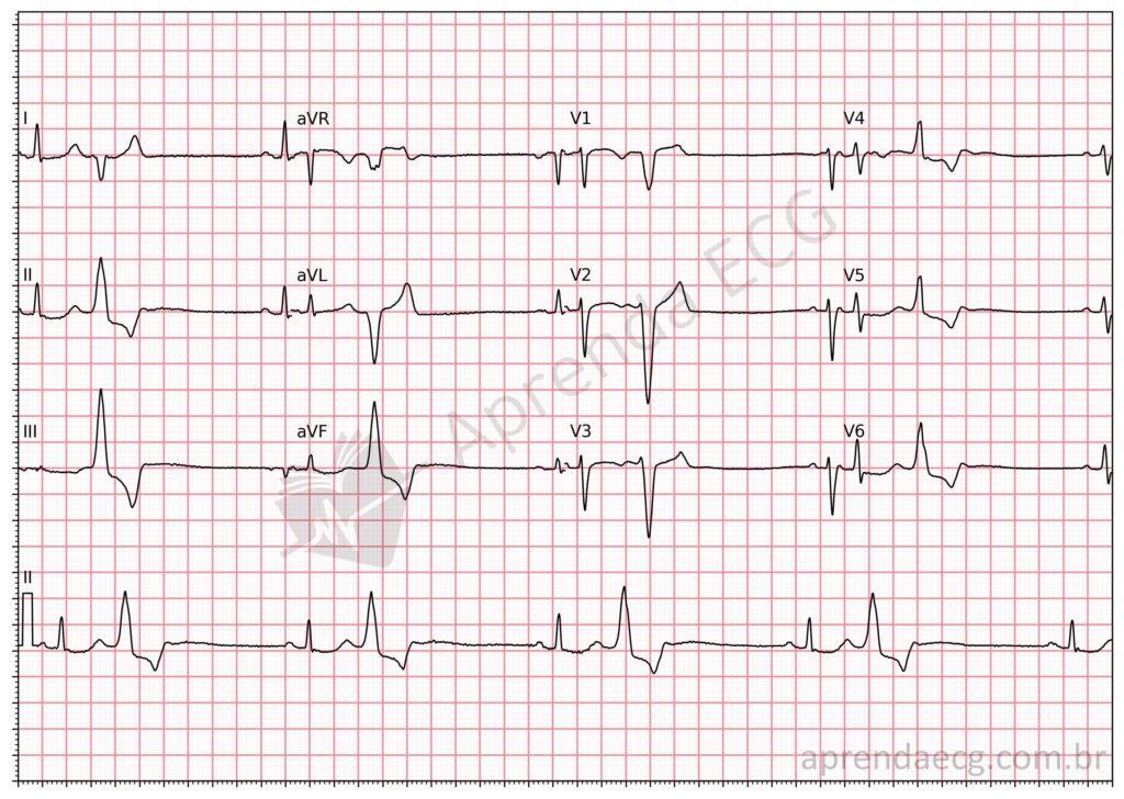 Electrocardiogram showing premature ventricular contractions (ventricular bigeminy)