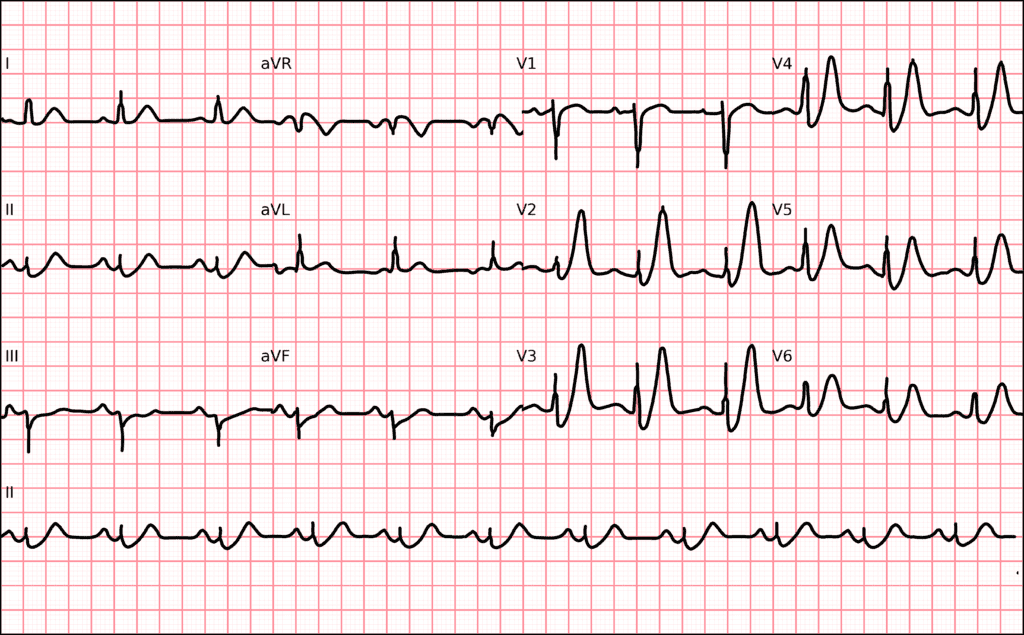 Electrocardiogram with the de Winter pattern