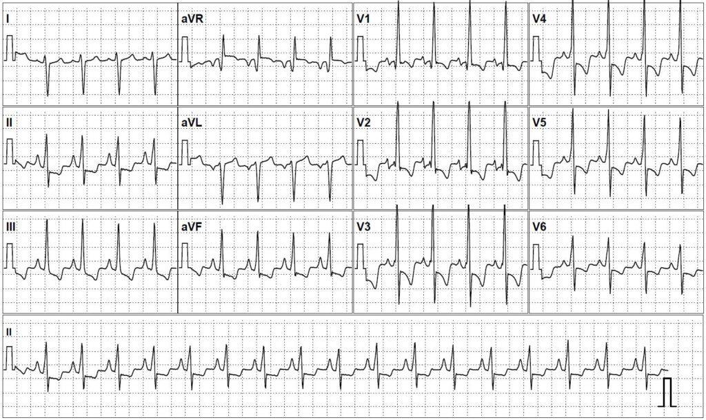 Electrocardiogram showing a qR pattern in V1 with right axis deviation