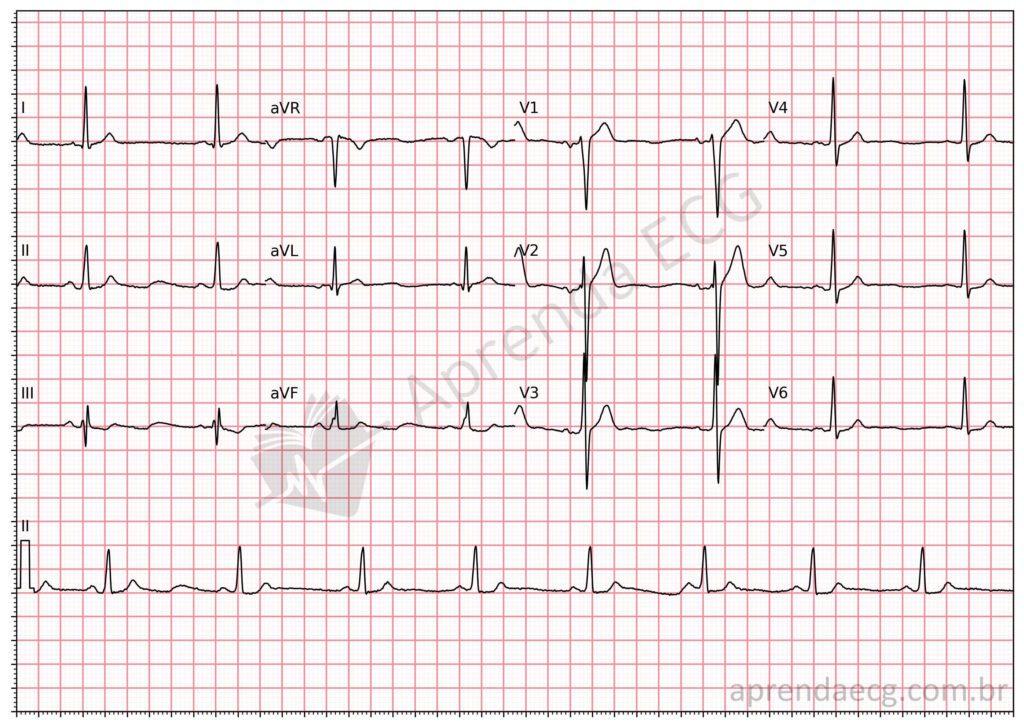 Electrocardiogram in hypercalcemia
