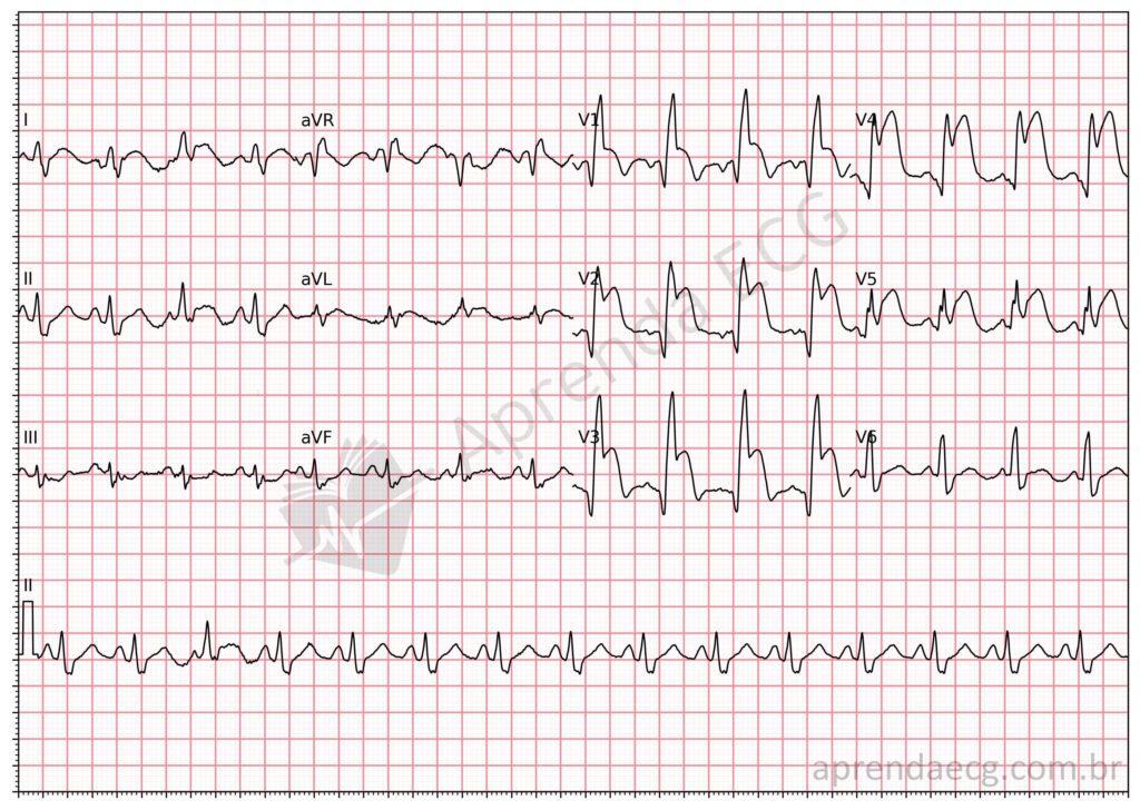 Electrocardiogram showing infarction with right bundle branch block