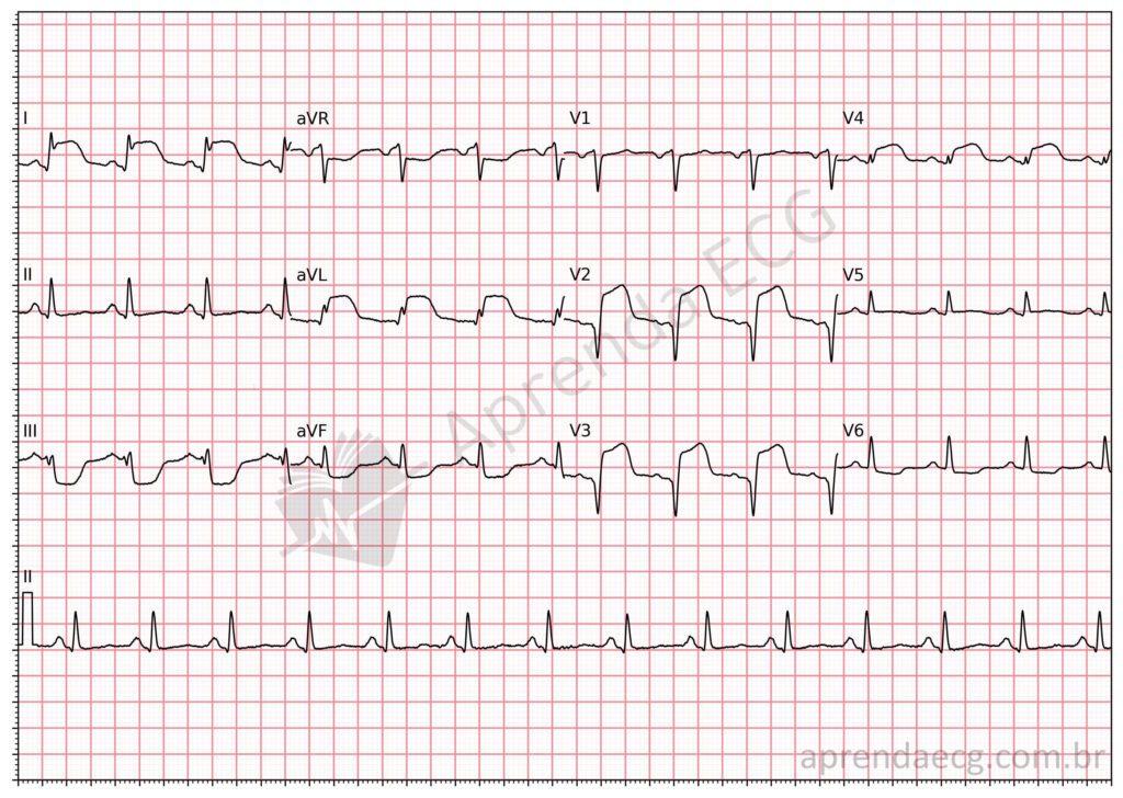 Electrocardiogram with a tombstone ST-elevation pattern