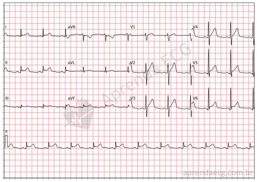 Electrocardiogram with acute pericarditis