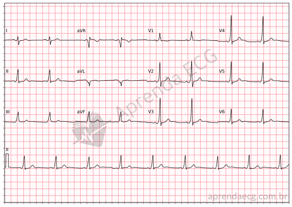 Electrocardiogram with ventricular pre-excitation showing a delta wave and a short PR