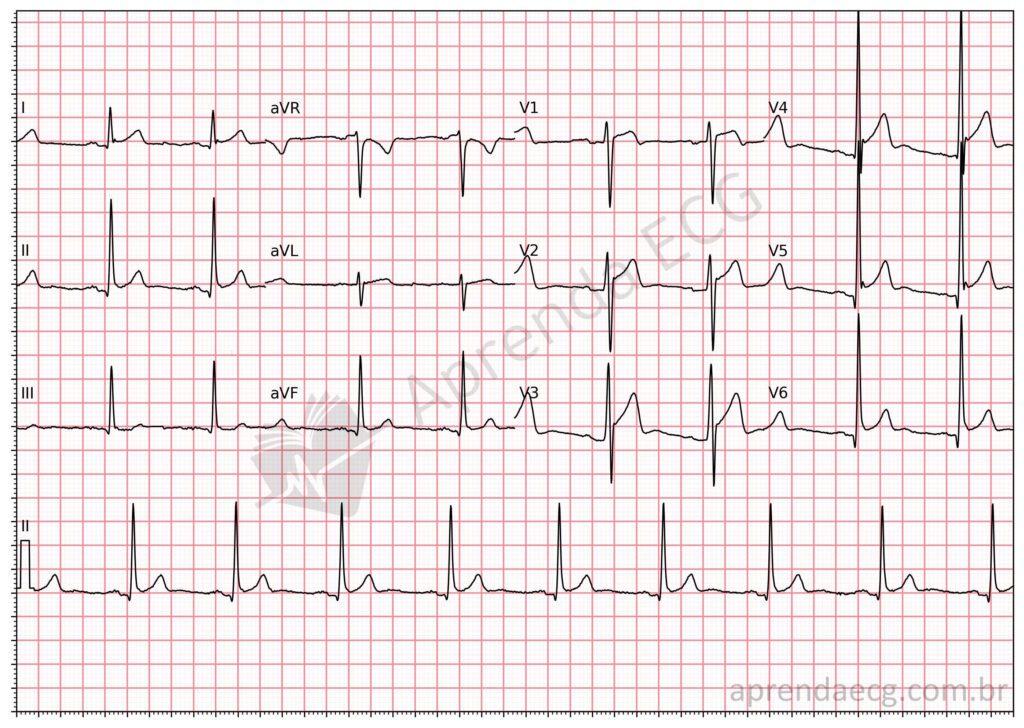 Electrocardiogram showing early repolarization