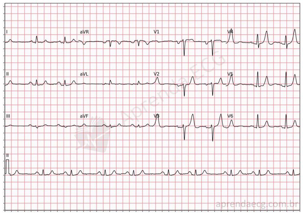 Electrocardiogram showing left atrial enlargement by the Morris index