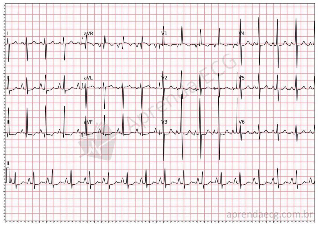Electrocardiogram meeting criteria for right ventricular hypertrophy and right atrial enlargement