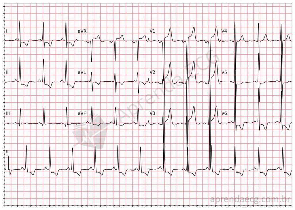 Electrocardiogram meeting criteria for left atrial enlargement and left ventricular hypertrophy