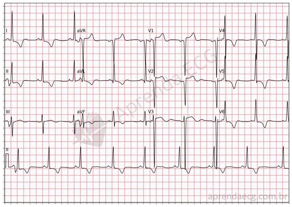 Electrocardiogram meeting criteria for left ventricular hypertrophy
