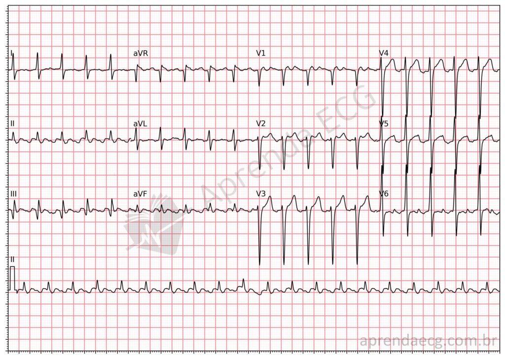 Electrocardiogram meeting criteria for left ventricular hypertrophy