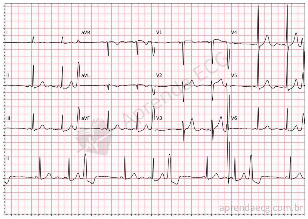 Electrocardiogram showing premature ventricular contractions (ventricular trigeminy)
