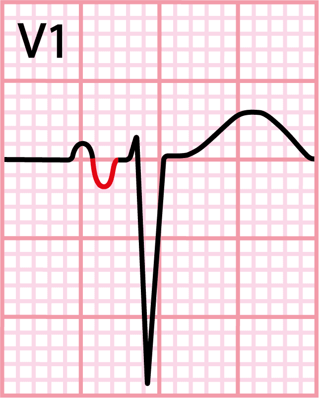 Morris index, a sign of left atrial enlargement on the electrocardiogram