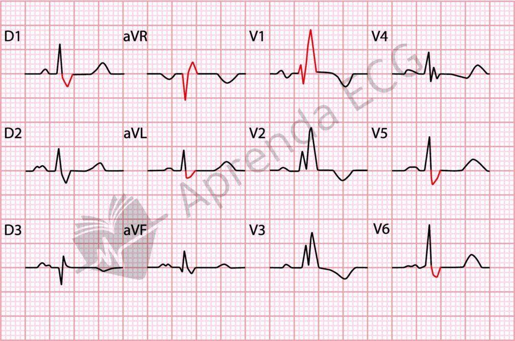 Right bundle branch block (RBBB)
